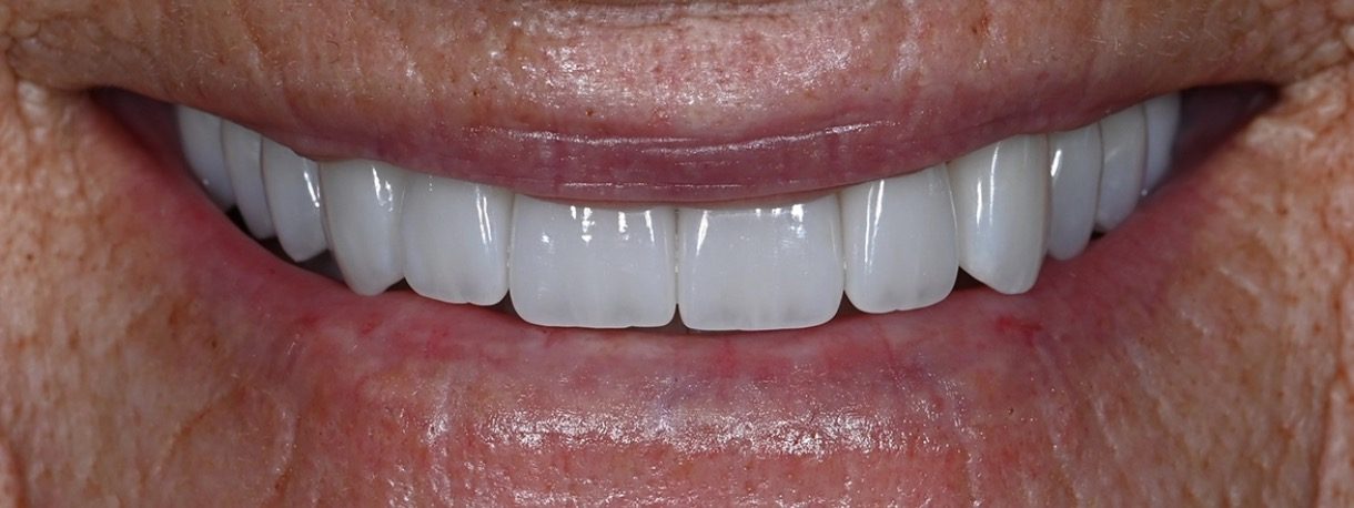 The same Love Dental patient smile after treatment