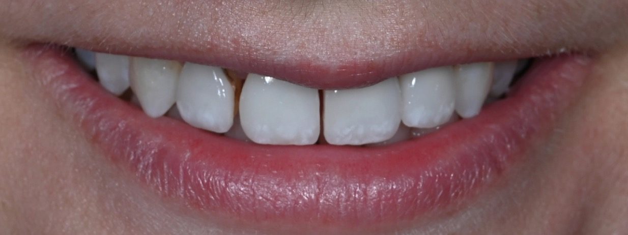 Real Love Dental patient smile before treatment
